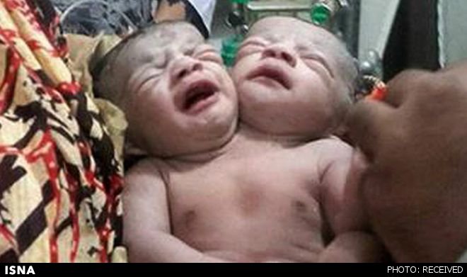 تولد نوزاد دو سر در بنگلادش+تصویر