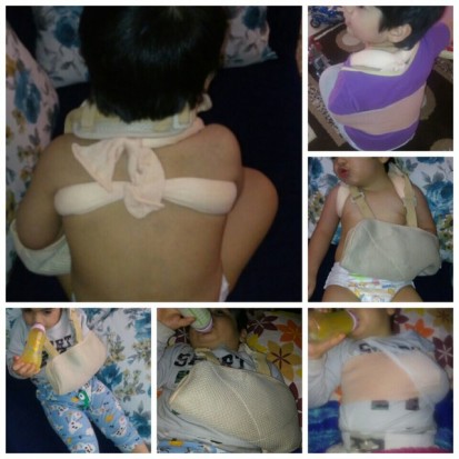 شکستن استخوان ترقوه‌ پسر 3 ساله در مهدکودک / تصاویر