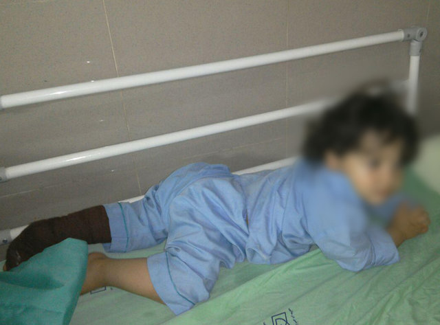 اسید، کودک دو ساله قزوینی را راهی بیمارستان کرد