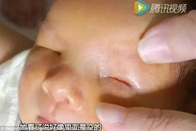 تولد نوزاد بدون چشم مادرش را شوکه کرد +تصاویر