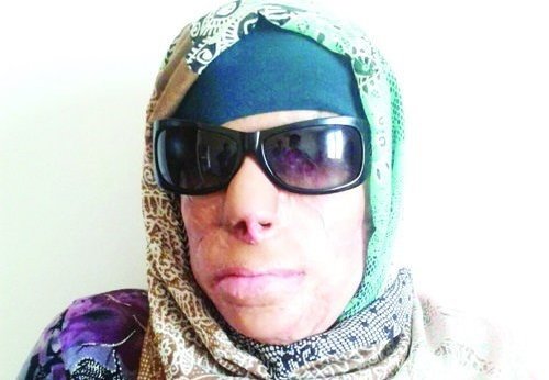 این زن قربانی اسیدپاشی برادران همسرش شد+تصاویر