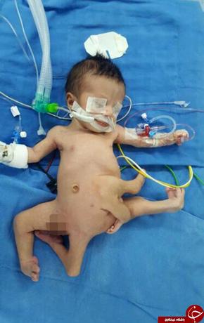 نوزادی با هشت دست و پا زیر تیغ جراحان رفت