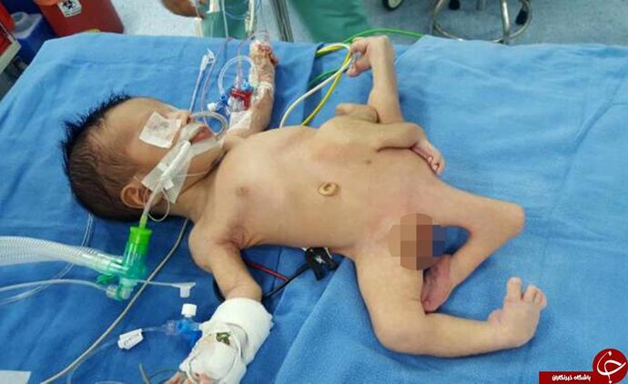 نوزادی با هشت دست و پا زیر تیغ جراحان رفت