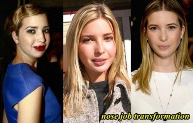 «ایوانکا ترامپ» قبل و بعد از عمل زیبایی! +تصاویر