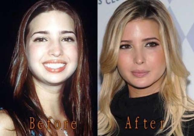 «ایوانکا ترامپ» قبل و بعد از عمل زیبایی! +تصاویر