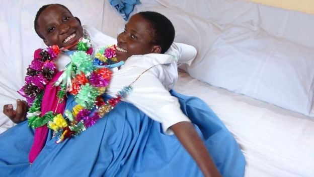 دو قلوهای به هم چسبیده تانزانیایی در ۲۲ سالگی درگذشتند+عکس