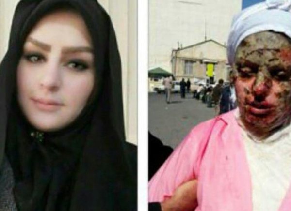 آخرین خبر از پرونده دختر مورد اسید پاشی تبریزی