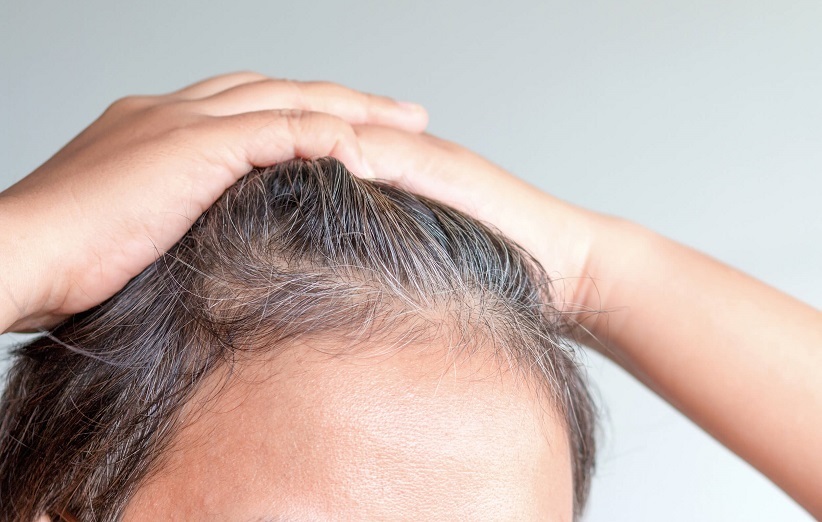 علت زود سفید شدن مو چیست؟