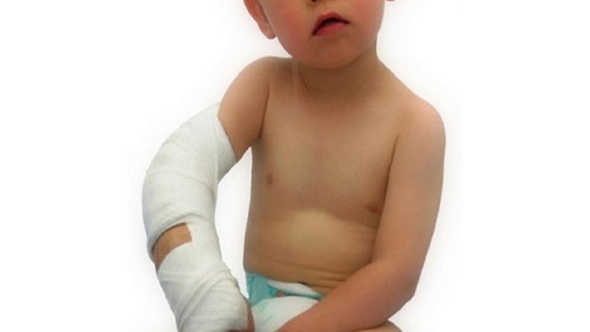 تشخیص شکستگی آرنج کودکان بدون استفاده از اشعه