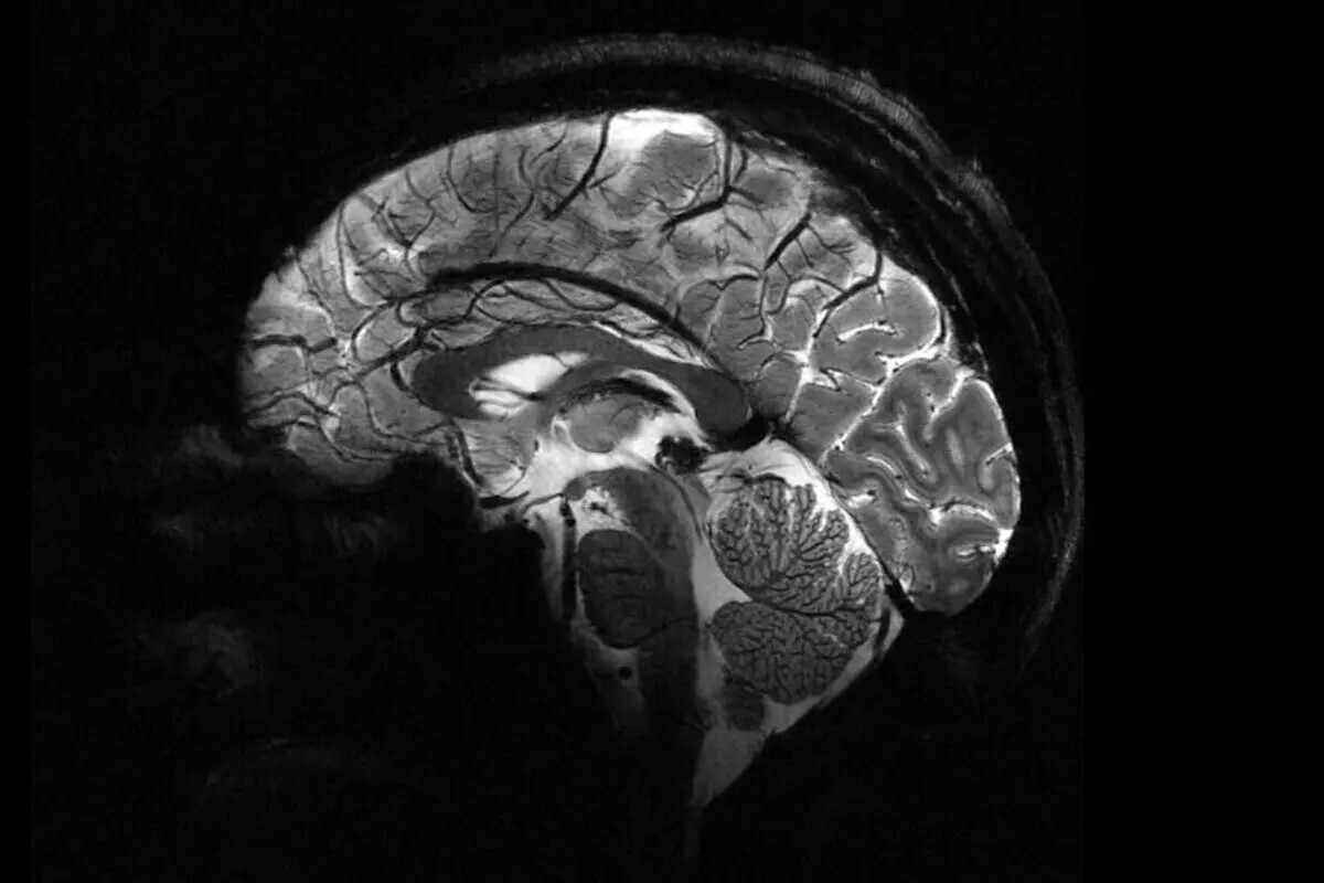 تصویر مغزی ثبت‌شده توسط قوی‌ترین دستگاه MRI جهان