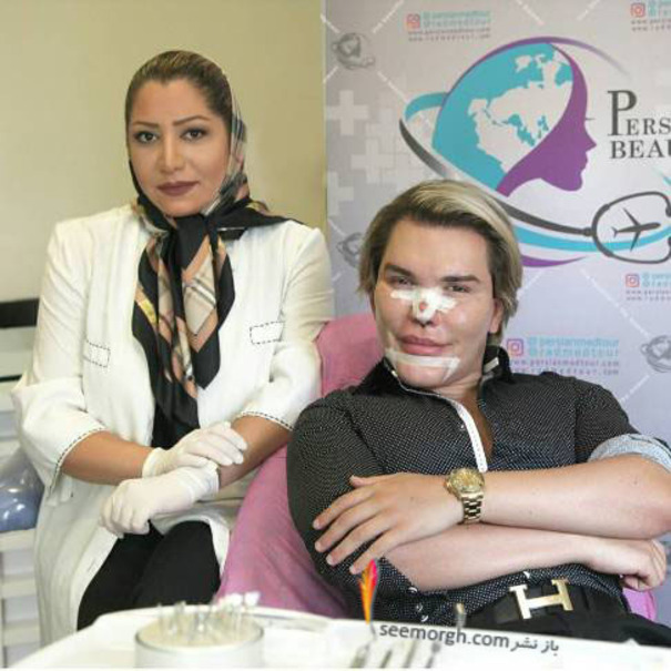 رکورددار جراحی زیبایی برای عمل بینی به ایران آمد!؟ +عکس