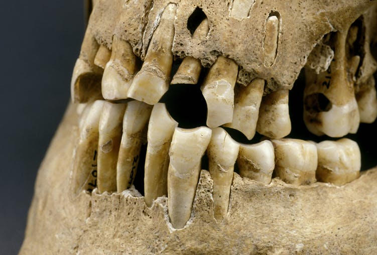 کشف علت سایش در دندان‌های اجداد ما