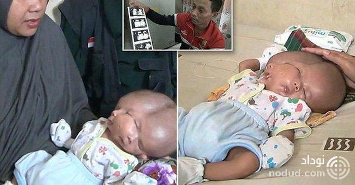 تولد نوزادی با دو مغز جهان را شوکه کرد ! + عکس