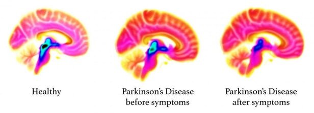 نشانه‌های پارکینسون ۲ دهه پیش از ظهور علائم این بیماری ظاهر می‌شوند