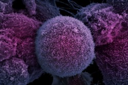 تشخیص زودهنگام سرطان پروستات با آزمایش ادرار