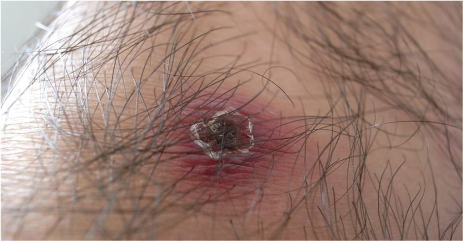 بیماری پوستی که در کمین دانشآموزان است بیماری پوستی که در کمین دانشآموزان است