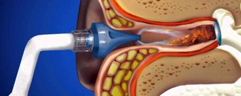 در مورد شست‌و‌شوی گوش چه می‌دانید؟