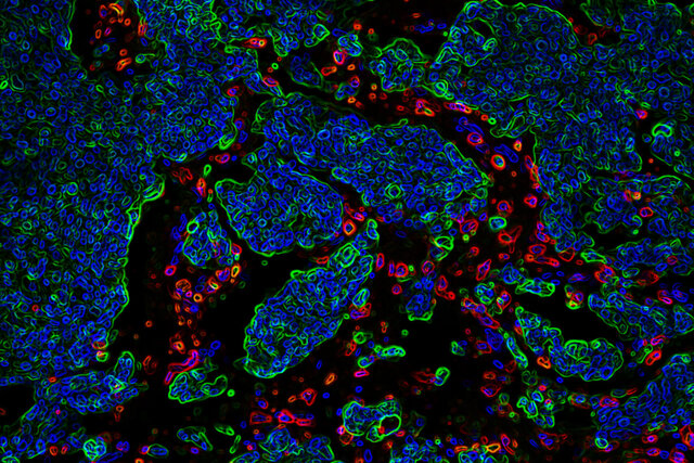 کشف پروتئینی که عامل متاستاز مغزی است کشف پروتئینی که عامل متاستاز مغزی است