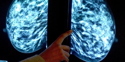 عوامل جدید تشدیدکننده سرطان سینه