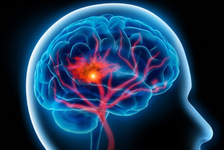 سن سکته مغزی به زیر ۵۰ سال آمده است+ علایم بیماری