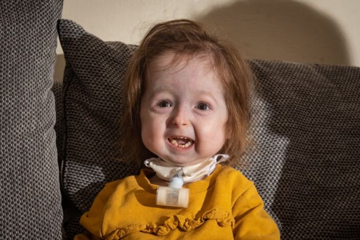 کودک ۲ ساله‌ای که به سرعت پیر می‌شود +عکس