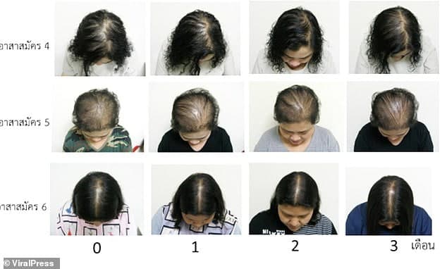 کشفی تازه برای درمان ریزش مو و طاسی کشفی تازه برای درمان ریزش مو و طاسی