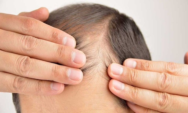 ریزش موی مرتبط با دیابت؛ دلایل و درمان