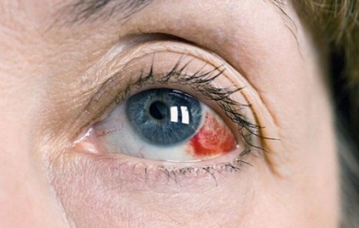لکه‌های قرمز چشم چه رازهایی درباره سلامت شما دارند؟