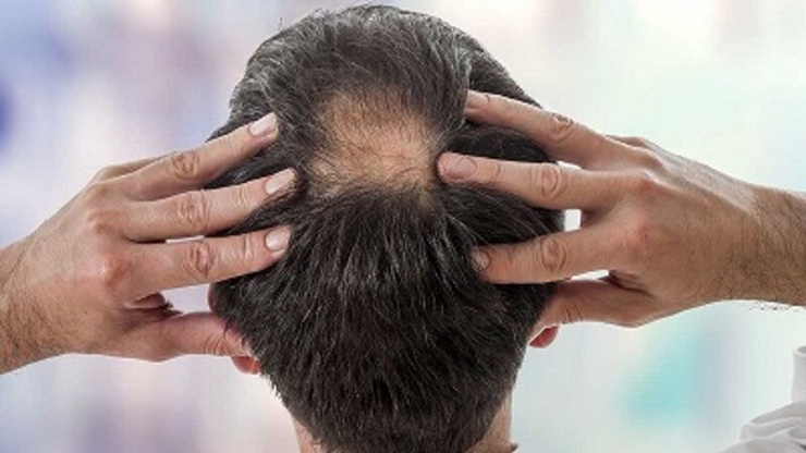 ریزش مو یکی از عوارض کروناست