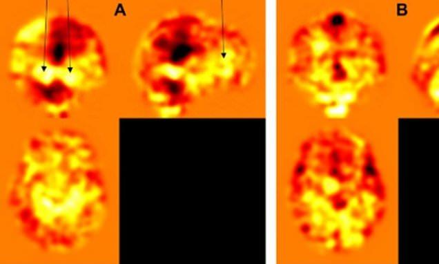ارتباط پیاده روی سریع و دوچرخه‌سواری با کاهش خطر ابتلا به آلزایمر