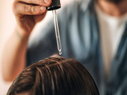 شوره سر چیست و چگونه درمان می شود؟ شوره سر چیست و چگونه درمان می شود؟