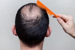 آیا بیماران کرونایی ریزش مو می گیرند؟