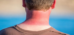 آفتاب سوختگی چگونه درمان می‌شود؟