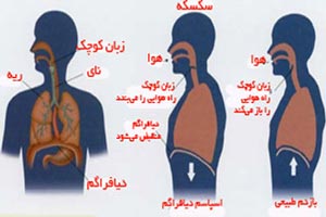 چرا سکسکه میکنیم؟ چرا سکسکه میکنیم؟