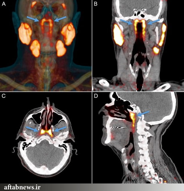 عکس| کشف اندام تازه در گلوی انسان