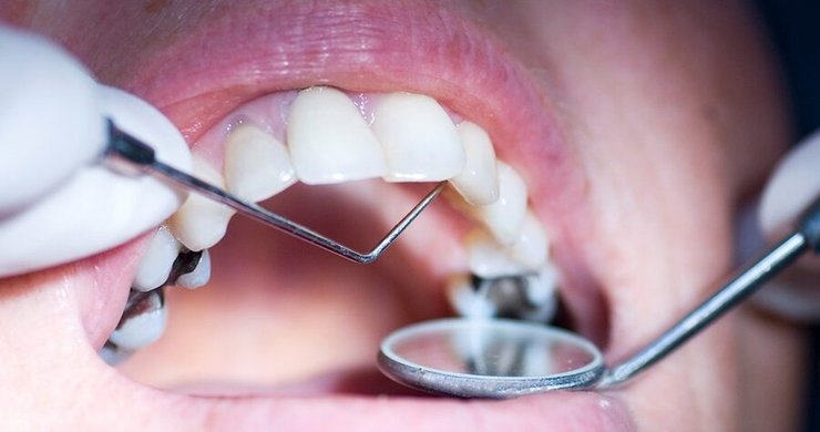 عوامل فرسایش مینای دندان و راه‌های پیشگیری