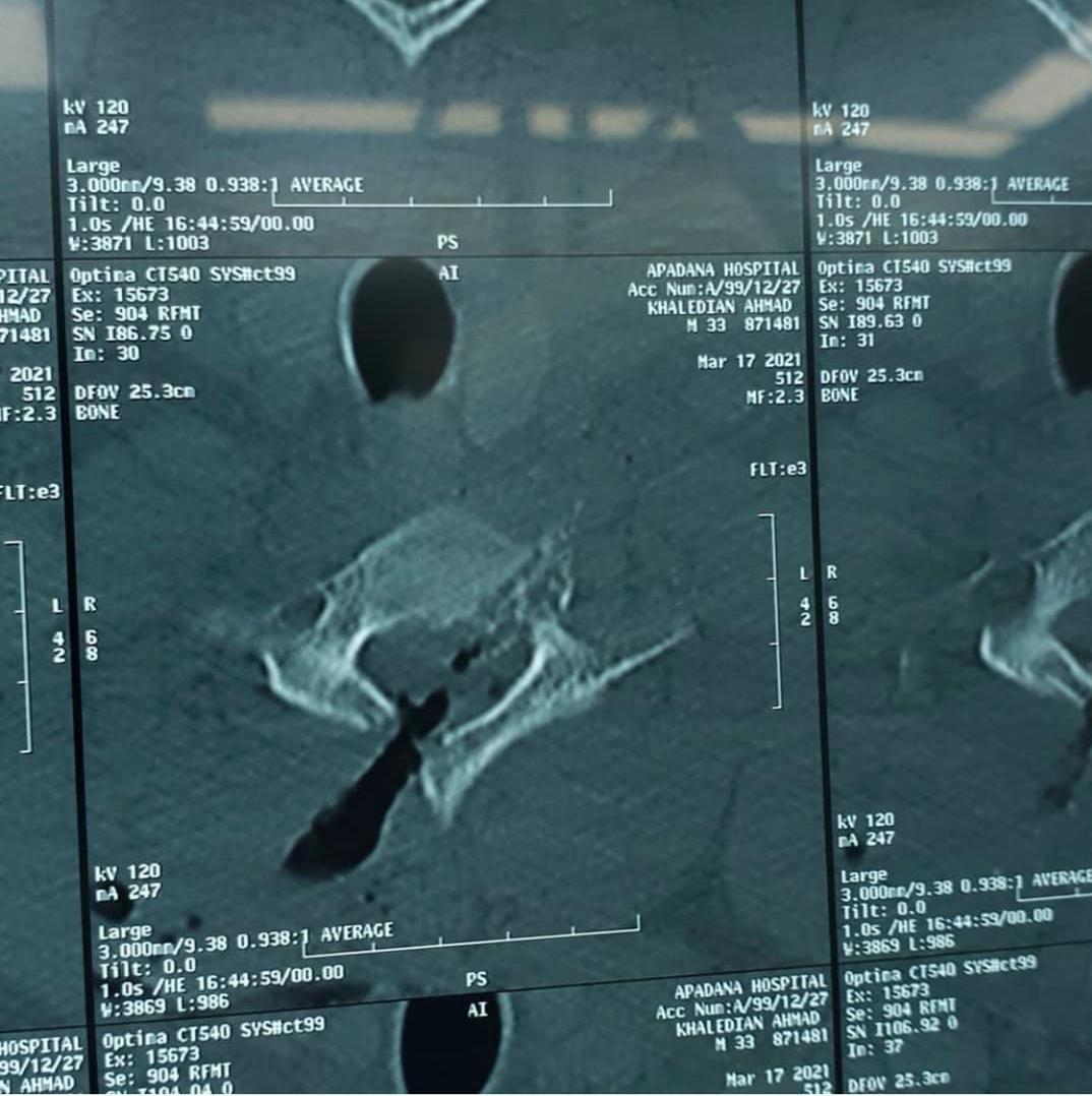 تیراندازی در مراسم عروسی دردساز شد