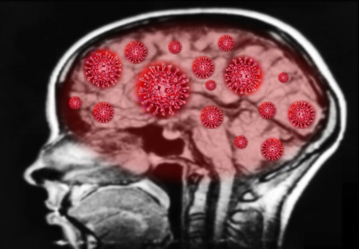 کروناویروس می‌تواند به مغز آسیب بزند؟