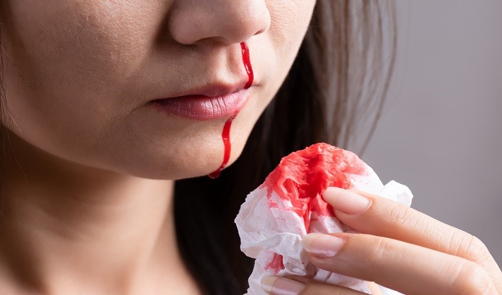 خون دماغ؛ علت، درمان و جلوگیری از آن خون دماغ؛ علت، درمان و جلوگیری از آن