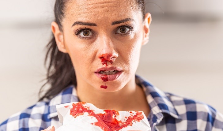 خون دماغ؛ علت، درمان و جلوگیری از آن خون دماغ؛ علت، درمان و جلوگیری از آن