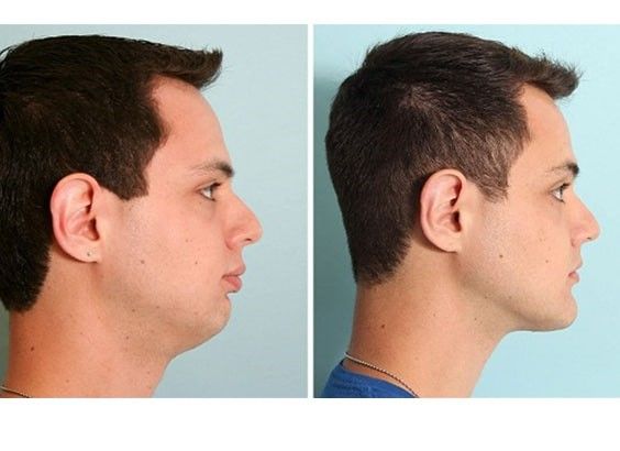 عکس| بهترین ژل برای زاویهسازی صورت/ عوارض ژل تقلبی عکس| بهترین ژل برای زاویهسازی صورت/ عوارض ژل تقلبی