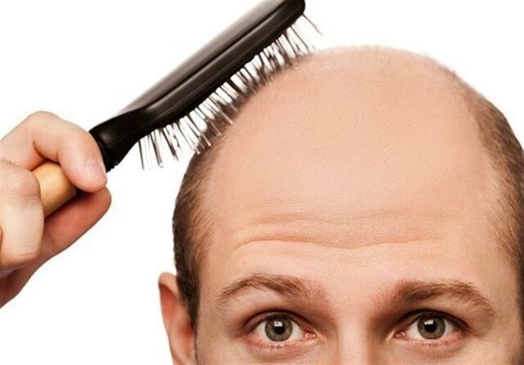 علل شایع ریزش مو در افراد و راه‌های درمان آن