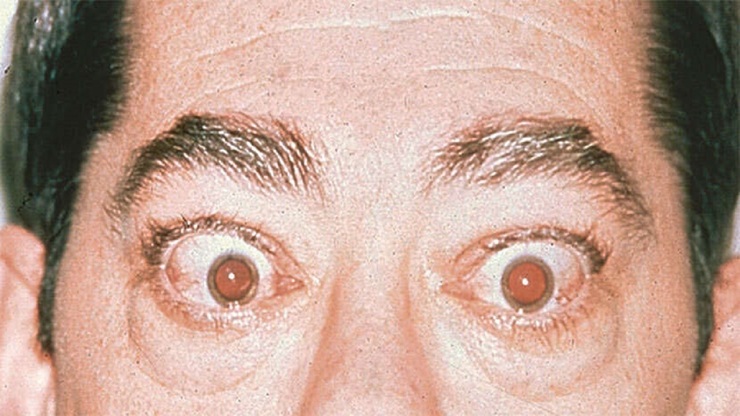 بلاهایی که بیماری خطرناک گریوز بر سر چشمان شما می‌آورد
