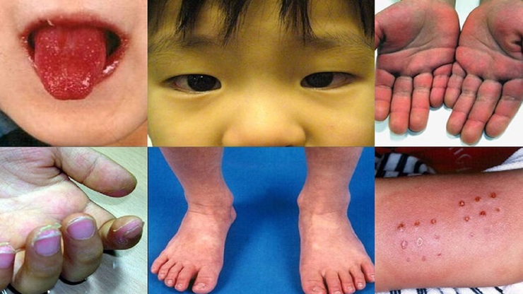 دردناک‌ترین علائم بیماری کاوازاکی در کودکان