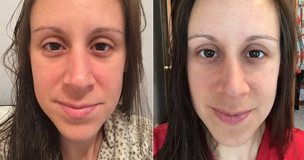 کافئین؛ از چای و قهوه تا راهکاری برای سلامت پوست کافئین؛ از چای و قهوه تا راهکاری برای سلامت پوست