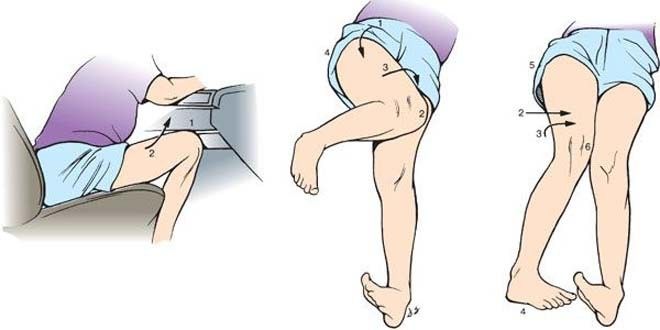 دررفتگی لگن و توانبخشی پس از آن؛ علت، علائم و تشخیص