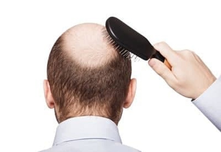آیا درمان قطعی ریزش مو حقیقت دارد؟