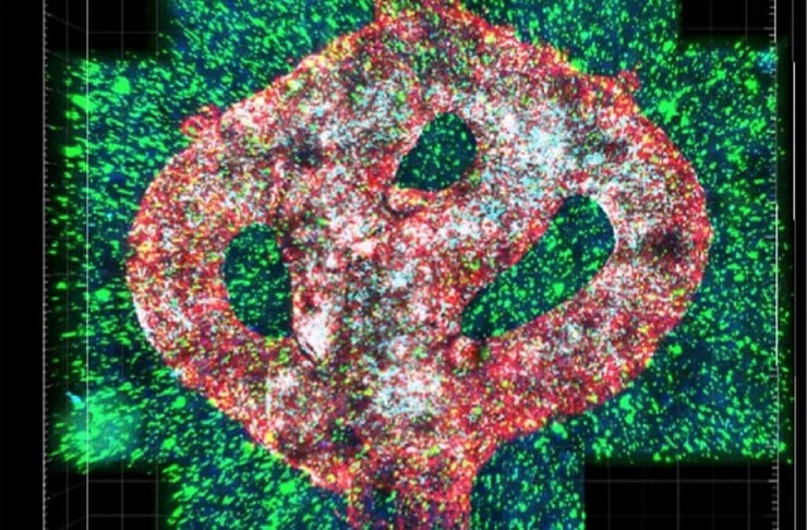 اولین تصویر سه بعدی از تومور بدخیم زنده مغز در جهان