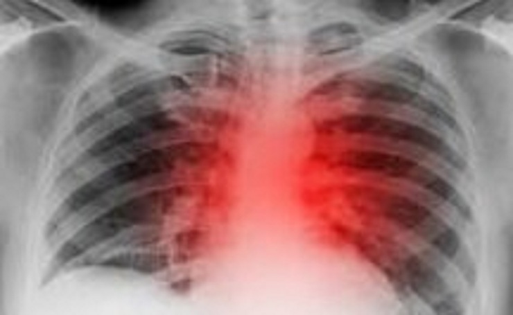 کاهش خطر بیماری قلبی با زندگی در مناطق سرسبز