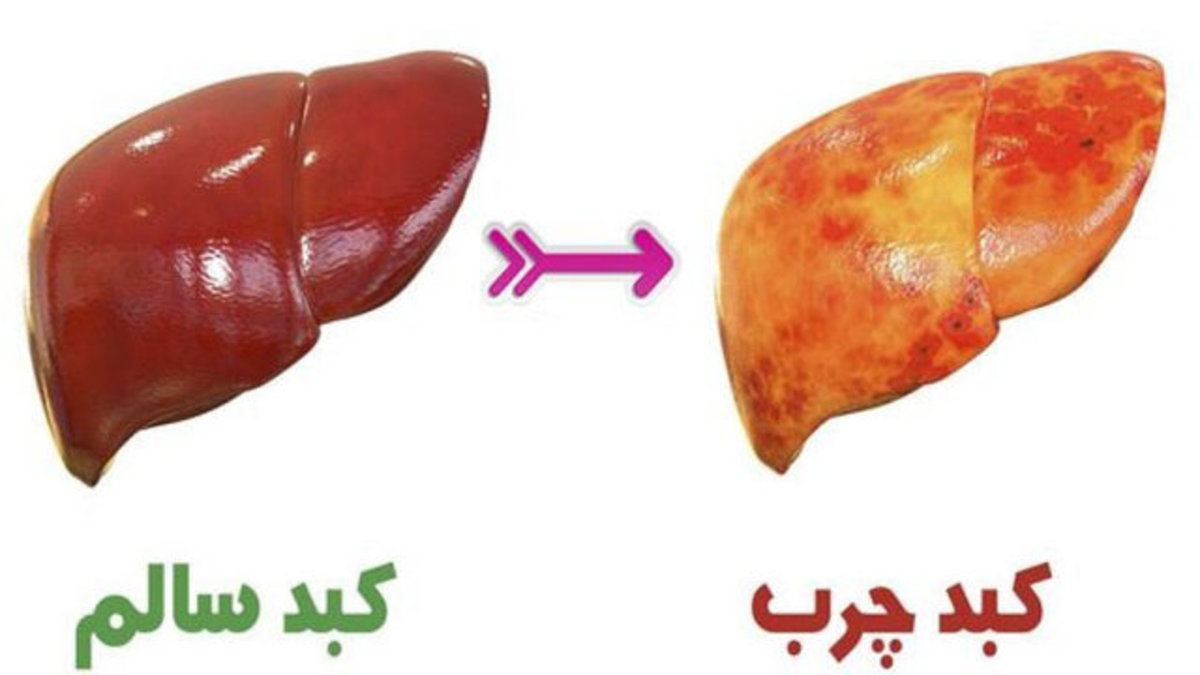 کبد چرب چگونه در بدن ایجاد می‌شود؟